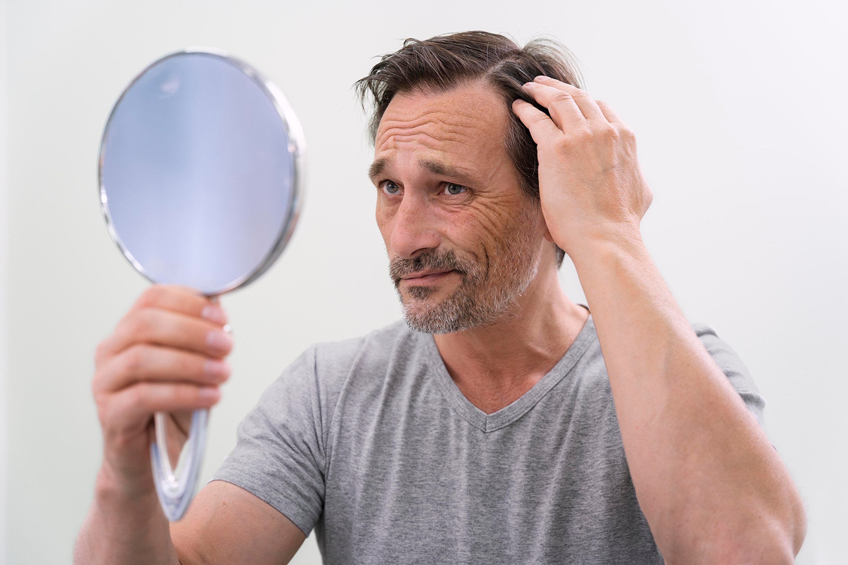 A man with a receding hairline in need of Hair Loss Treatment.