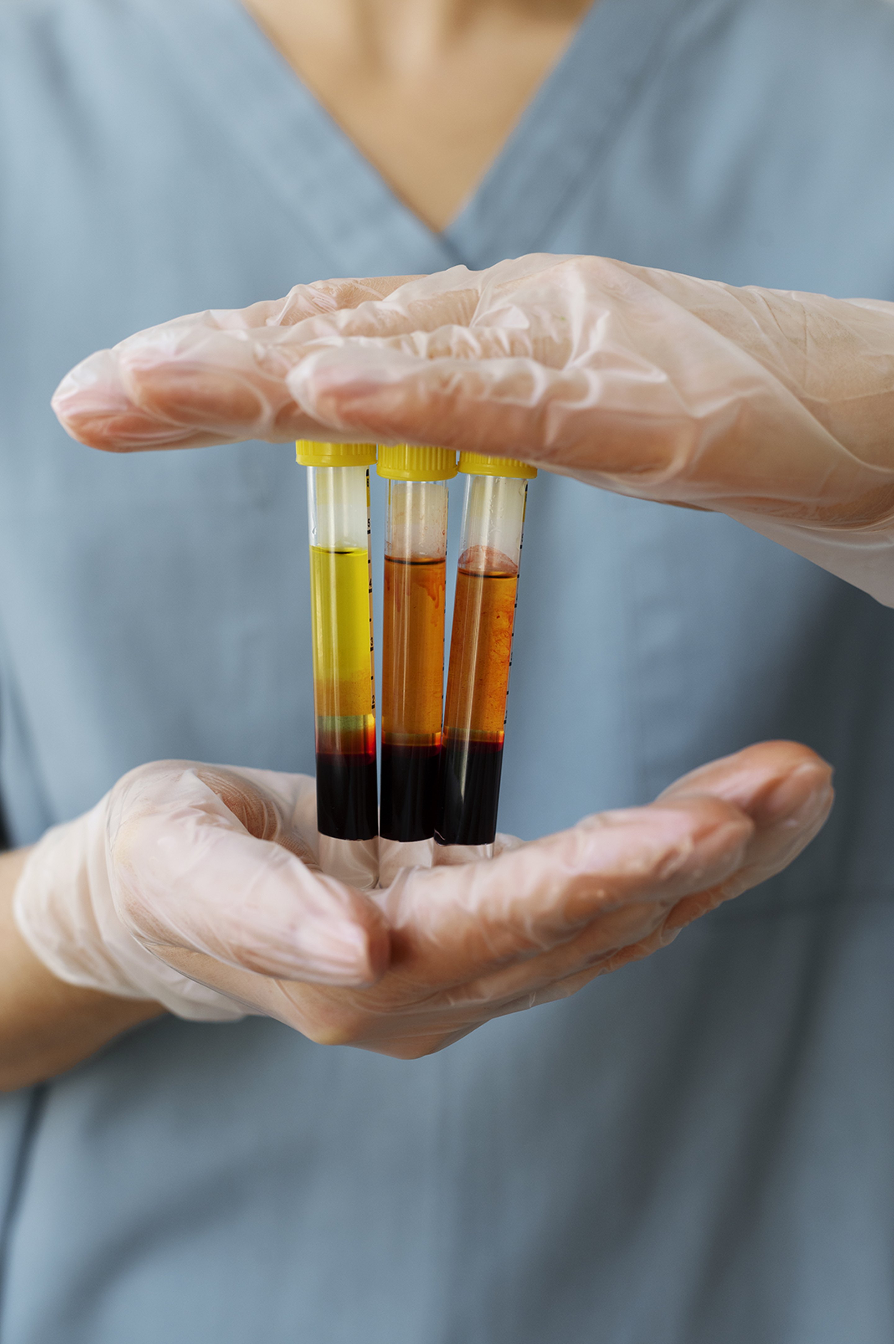 A medical professional holding a rack of test tubes with platelet rich plasma.