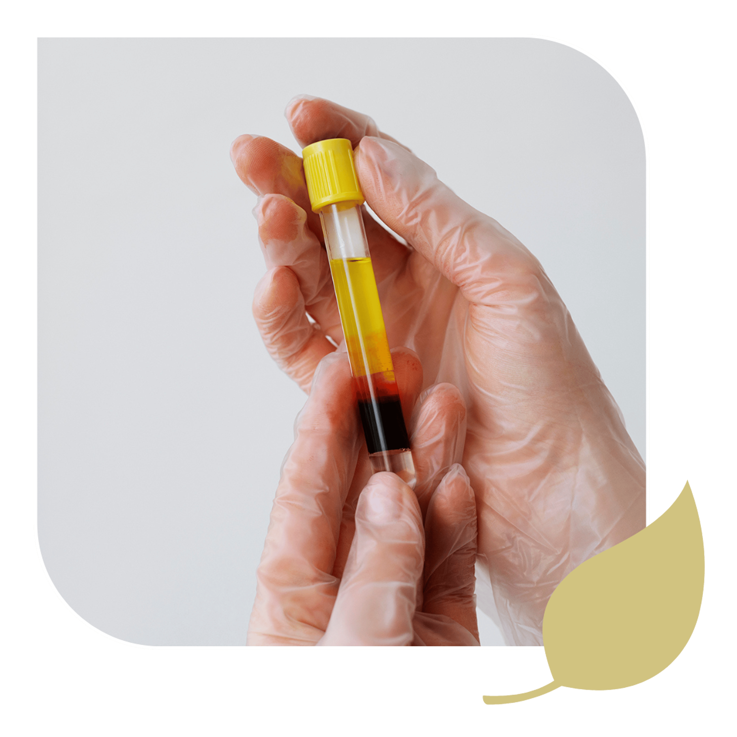 A doctor holds a flask, preparing a dose of regenerative PRP in Stuart, FL.